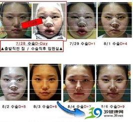 削唇手术前后照片,削唇手术前后惊人变化